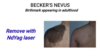 Puberty or Adult Birthmark treatment @DrArifMDDermatologist