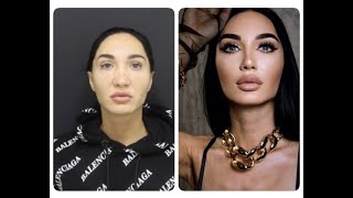 (GÖRÜNTÜ TELİFİ) Rhinoplasty Before After Show Rhinoplasty Nose Job, Closed Rhinoplasty