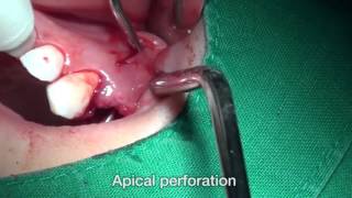 Maxillary premolar Cystic lesion using INNO and CowellBMP