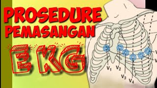 Prosedure pemasangan EKG,  SOP pemasangan EKG.