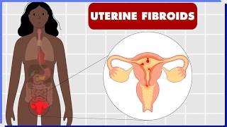 Easily Understand Fibroids: Doctor Explains