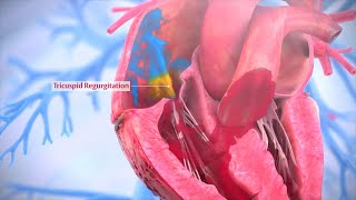 Tricuspid Valve Repair - Triluminate Clinical Trial