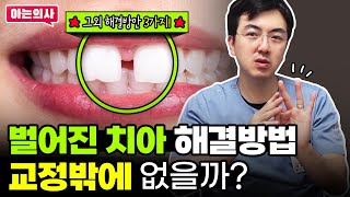 치아사이 벌어짐 치아교정 아니어도 치료 가능합니다