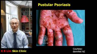 Psoriasis