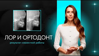 ЛОР-врач и врач-ортодонт: результат совместной работы