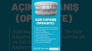 AÇIK KAPANIŞ(OPEN BITE), INVISALIGN TEDAVİSİ