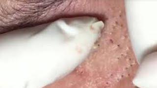 How to Pop a Pimple, Pimple Popping, Acne Blackheads Removal