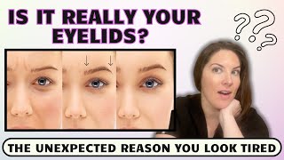 Heavy Eyelids Weighing You Down? The Surprising Reason You Never Expected