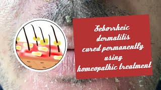 Seborrheic dermatitis with multiple problem cured using homeopathic treatment