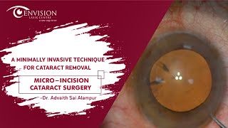 Experience Clear Vision with Micro-Incision Cataract Surgery  by Dr. Advaith Sai Alampur #shorts