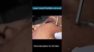 Laser Mole Removal || मस्से का स्थायी इलाज लेजर द्वारा #lasertreatment #shorts #mole #ashortaday