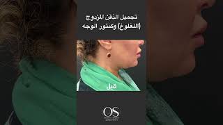 #تجميل #تجميليه #تجميل_الرقبة #تجميل_اللغلوغ #شفط_دهون  للتواصل 0545149002