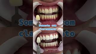 Clareamento dental.  Yamar odontologia Londrina