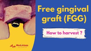 Free gingival graft - The technique