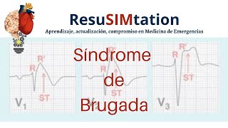 Síncope Síndrome de Brugada