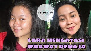 CARA MENGHILANGKAN JERAWAT BAGI REMAJA || TiaraNab