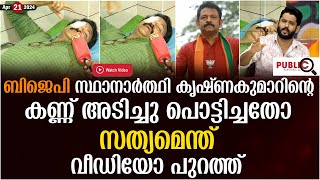 ബിജെപി സ്ഥാനാർത്ഥി കൃഷ്ണകുമാറിന്റെ കണ്ണ് അടിച്ചു പൊട്ടിച്ചതോ? സത്യമെന്ത്?| krishna kumar g