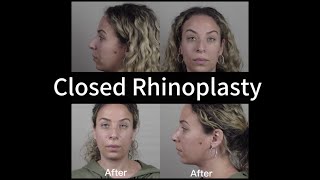 Closed Rhinoplasty Surgery