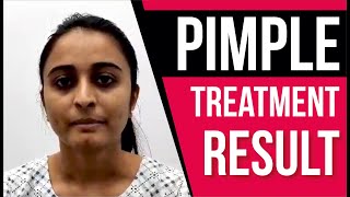 Best Pimple Treatment Testimonials | Pimple Treatment Review | Sakhiya Skin Clinic Review |