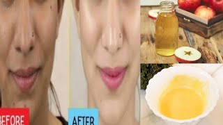 Skin Whitening & Dark Spots Removal Apple Cider Vinegar Face Pack to get Fair & Spotless Skin