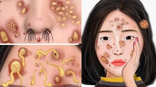 ASMR Giant Acne & Black Head Pimple Removal & Nose Care | Acne Deep Cleaning Animation