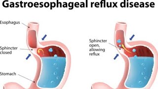 Gastroesophageal Reflux -GERD -Sign and Symptoms of Gerd