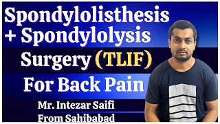 Spondylolisthesis + spondylolysis surgery (TLIF) for back pain |