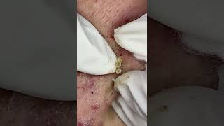 Big Cystic Acne Blackheads Extraction Blackheads & Milia, Whiteheads Removal Pimple Popping #shorts