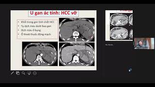 Chẩn đoán hình ảnh cấp cứu bụng không do chấn thương | PGS. Lê Thanh Dũng