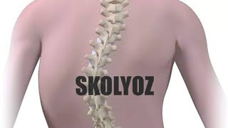 SKOLYOZ AMELİYATI ANİMASYONU