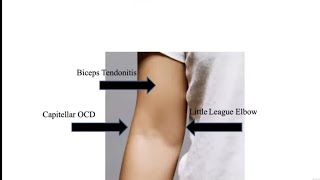 Osteochondral Lesions of the Elbow