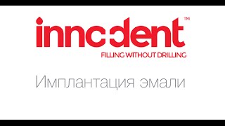 Имплантация эмали InnoDent: Инструкция