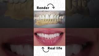 Brand New Smile with Full Mouth Restoration in Mexico! - Sani Dental Group