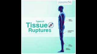 Rupture Types | Columbia Asia Hospital - India