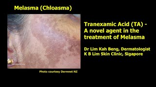 Tranexamic Acid (TA) - a novel agent in the treatment of Melasma (Chloasma)