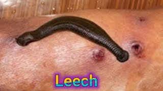 Leech #Leechtherapy