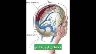 (٢) اشهر اسباب ارتفاع ضغط الدماغ | ارتفاع ضغط الراس