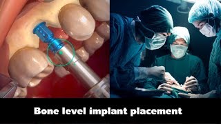 Dental implant animation - Bone level implant placement รากฟันเทียม