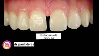 Fechamento de Diastema