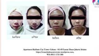 0811 1721 280, Biar hidung mancung di Kalibata City Rinanda  Skin Care Center