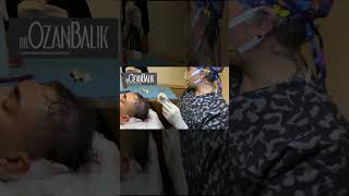 Hair Transplant Turkey | Best Hair Transplant in Turkey | Before-After #hairtransplant