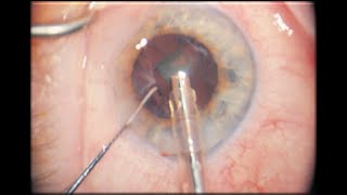 Principles of ophthalmic surgery