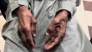 Demonstration of Parkinson’s Tremor (Unilateral pill rolling Resting tremor)#parkinson #tremor 🧠