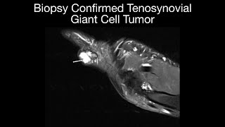 Biopsy Confirmed Tenosynovial Giant Cell Tumor: