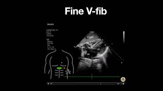 Fine Ventricular Fibrillation