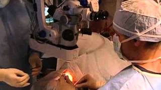 Surgery to Correct Cataract and Astigmatism for Legally Blind Patient - Assil Eye Los Angeles