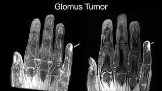 Glomus Tumor