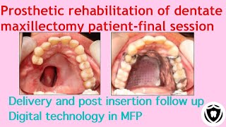 prosthetic rehabilitation of dentate maxillectomy patient - final session