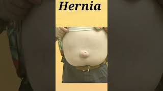 Hernia short knowledge