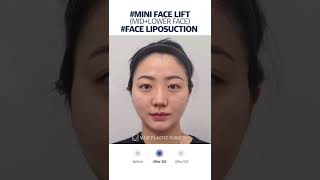 [B&A] Mini Facelift in Korea Plastic Surgery #shorts